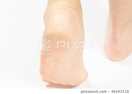 中老年女性腳跟裂紋角化病 中老年女性腳跟裂紋角化病 48343518