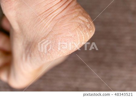 中老年女性腳跟裂紋角化病 中老年女性腳跟裂紋角化病 48343521