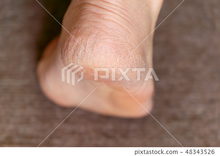 Middle and aged female heel crack keratosis 48343526