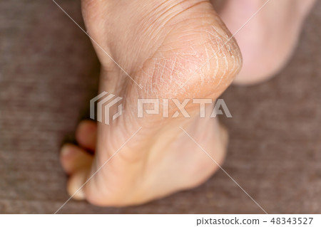 中老年女性腳跟裂紋角化病 中老年女性腳跟裂紋角化病 48343527