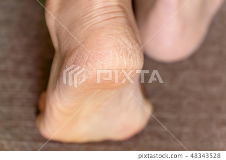 中老年女性腳跟裂紋角化病 中老年女性腳跟裂紋角化病 48343528