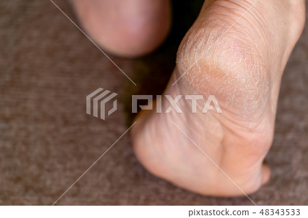 Middle and aged female heel crack keratosis Middle and aged female heel crack keratosis 48343533
