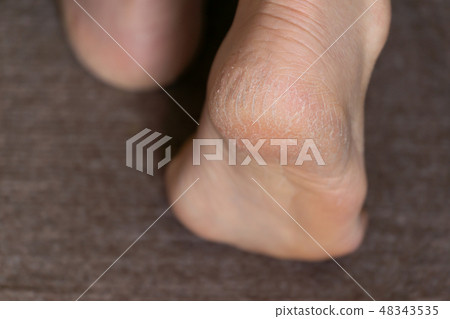Middle and aged female heel crack keratosis 48343535