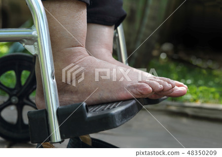 Elderly woman swollen feet press test on wheelchair Elderly woman swollen feet press test on wheelchair 48350209