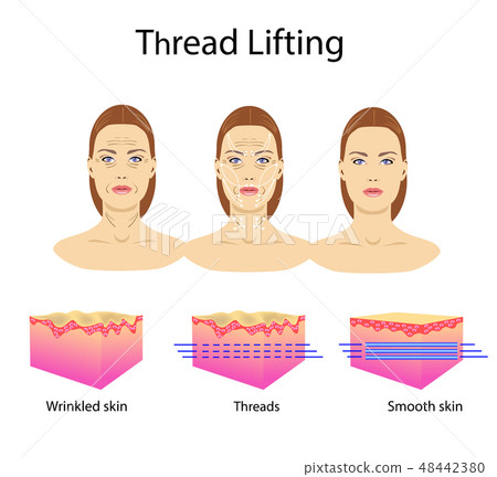 Thread lifting, vector illustration, face of girl Thread lifting, vector illustration, face of girl 48442380