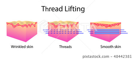 Thread lifting, vector illustration and skin cells Thread lifting, vector illustration and skin cells 48442381