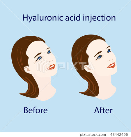 hyaluronic acid injection, before and affect hyaluronic acid injection, before and affect 48442496