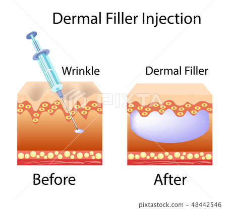 Vector illustration cosmetic filler Dermal fillers Vector illustration cosmetic filler Dermal fillers 48442546