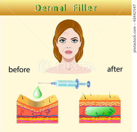 illustration with cosmetic filler Dermal fillers illustration with cosmetic filler Dermal fillers 48442547