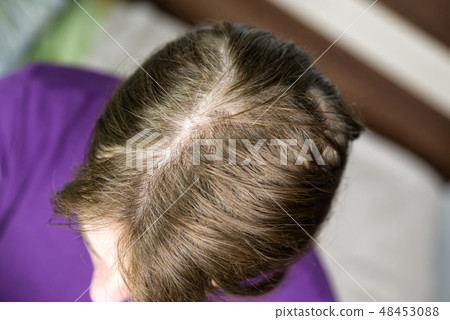 Hair loss female. Alopecia areata Hair loss female. Alopecia areata 48453088