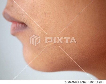 Scars on the face Scars on the face 48503309