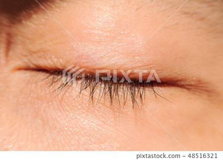 Blepharitis or Eyelid inflammation healthy eyes 48516321
