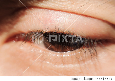 Blepharitis or Eyelid inflammation healthy eyes 48516325