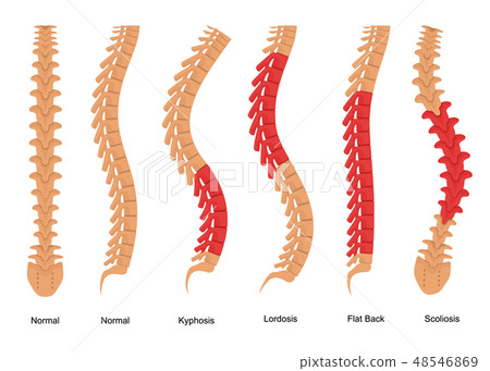 Osteoporosis Bone Types Infographics Concept Card Poster. Vector Osteoporosis Bone Types Infographics Concept Card Poster. Vector 48546869