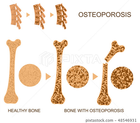 Osteoporosis Bone Infographics Concept Card Poster. Vector 48546931