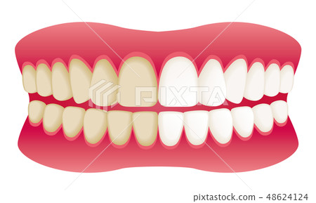 Teeth whitening before after ad illustration Teeth whitening before after ad illustration 48624124