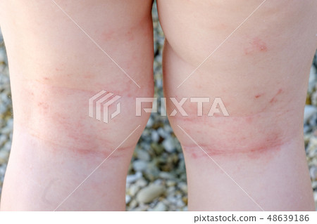 skin irritation newborn closeup atopic dermatitis skin irritation newborn closeup atopic dermatitis 48639186