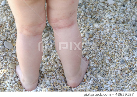skin irritation newborn atopic dermatitis legs skin irritation newborn atopic dermatitis legs 48639187