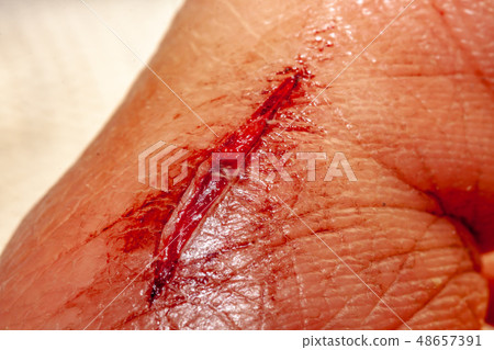 One photo of a series of photos taken of a fresh bleeding cut development over a priod of 90 minutes One photo of a series of photos taken of a fresh bleeding cut development over a priod of 90 minutes 48657391