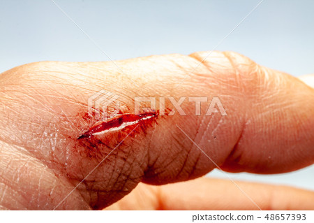 One photo of a series of photos taken of a fresh bleeding cut development over a priod of 90 minutes One photo of a series of photos taken of a fresh bleeding cut development over a priod of 90 minutes 48657393