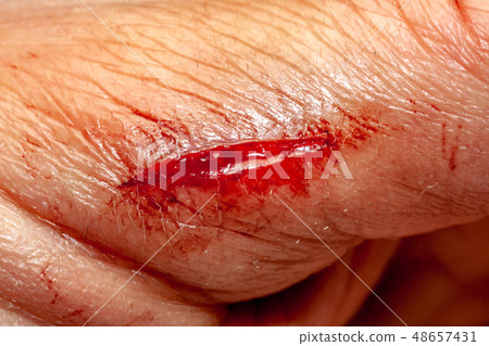 One photo of a series of photos taken of a fresh bleeding cut development over a priod of 90 minutes One photo of a series of photos taken of a fresh bleeding cut development over a priod of 90 minutes 48657431