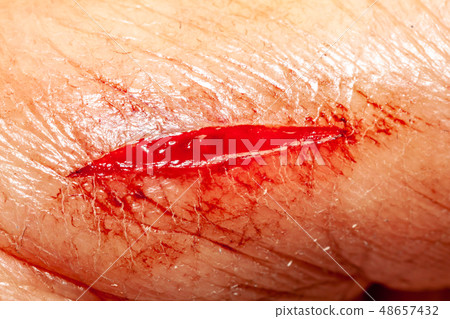 One photo of a series of photos taken of a fresh bleeding cut development over a priod of 90 minutes One photo of a series of photos taken of a fresh bleeding cut development over a priod of 90 minutes 48657432