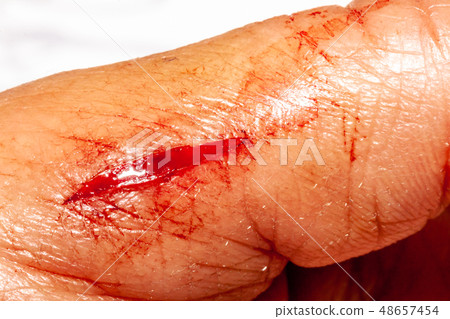 One photo of a series of photos taken of a fresh bleeding cut development over a priod of 90 minutes One photo of a series of photos taken of a fresh bleeding cut development over a priod of 90 minutes 48657454