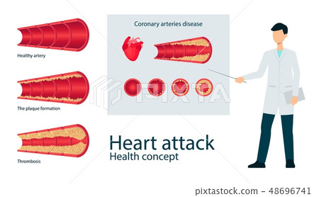 Vector atherosclerosis vein artery throms flat set Vector atherosclerosis vein artery throms flat set 48696741