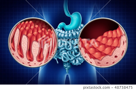 Celiac Intestine Disease Celiac Intestine Disease 48738475