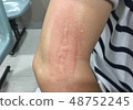 Redness, from scar treatment laser, on an arm 48752245