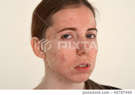 beautiful young girl with problematic skin, acne 48797499