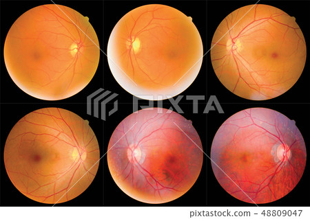 retinal images 48809047
