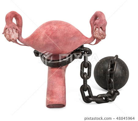 Uterus disease concept. Human uterus with shackle Uterus disease concept. Human uterus with shackle 48845964