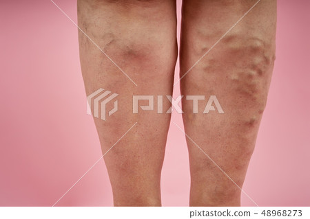 legs of senior woman with varicose veins on coral background. legs of senior woman with varicose veins on coral background. 48968273