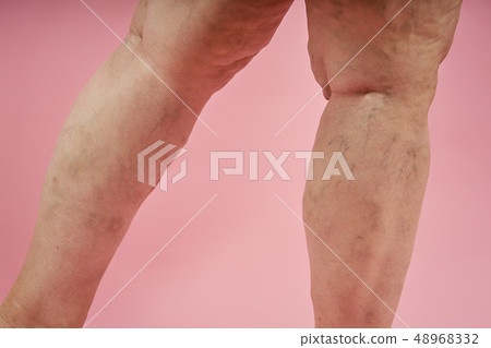 legs of senior woman with varicose veins on coral background. legs of senior woman with varicose veins on coral background. 48968332