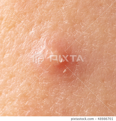 Acne on the human skin as a background Acne on the human skin as a background 48986701