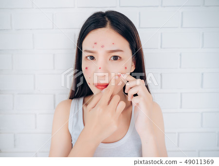 Asian woman squeeze acne cheeks problem face 49011369