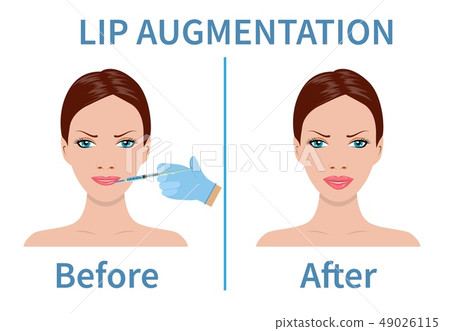 Lip augmentation with hyaluronic acid. 49026115