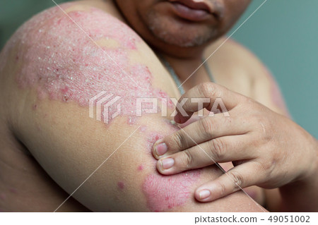 People with psoriasis look at their arms full of 49051002