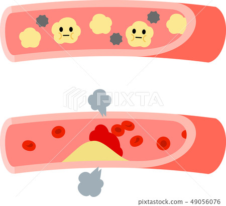 Intracellular neutral fat and atheroma 49056076