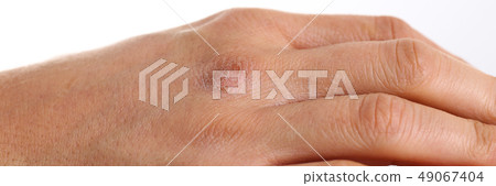 Damaged male arm with corrupted dry skin 49067404
