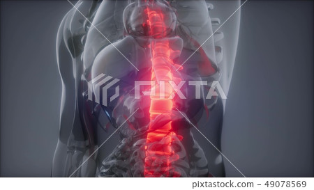 Backache in Back Bones Backache in Back Bones 49078569
