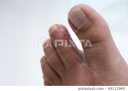 Finger on the leg. Purulent wound on the leg. Eczema. Dermatitis. Psoriasis. Finger on the leg. Purulent wound on the leg. Eczema. Dermatitis. Psoriasis. 49112960