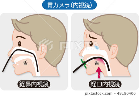 胃鏡檢查(經鼻內窺鏡和口腔內窺鏡)的解釋性視圖(帶錶達式) 胃鏡檢查(經鼻內窺鏡和口腔內窺鏡)的解釋性視圖(帶錶達式) 49180406