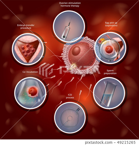 IVF Manually Combining Egg and Sperm in Lab Dish 49215265