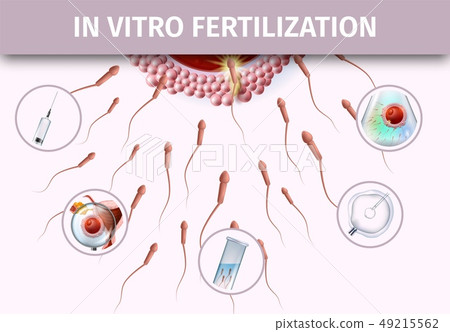 Artificial Insemination Infographic Aid Banner 49215562