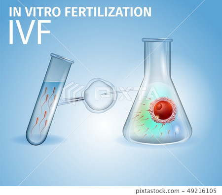 Methods of Infertility Treatment, IVF, Egg, Sperm 49216105