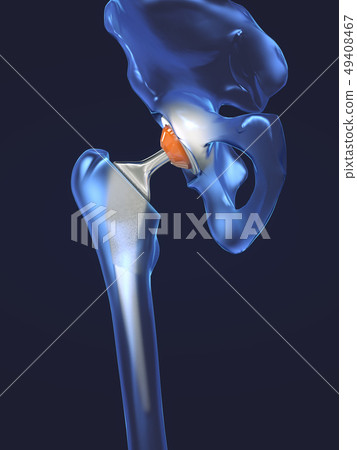 Function of a hip joint implant or hip prosthesis Function of a hip joint implant or hip prosthesis 49408467