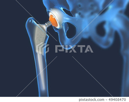 Function of a hip joint implant or hip prosthesis 49408470