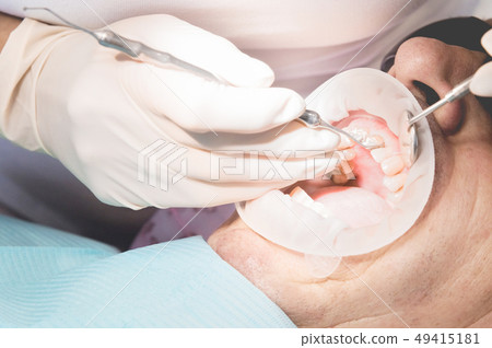 Extreme macro closeup of an open male human mouth showing the preparation for the installation of Extreme macro closeup of an open male human mouth showing the preparation for the installation of 49415181